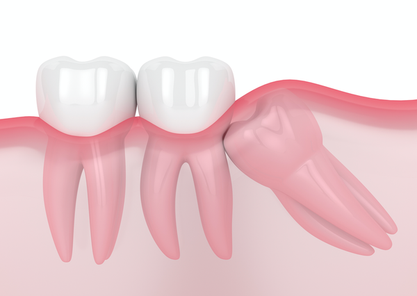 Răng khôn có thể có nhiều vấn đề dẫn tới nhổ bỏ.