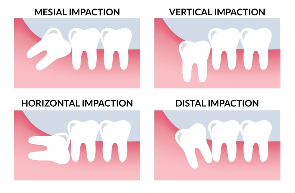 WISDOM TOOTH EXTRACTION – HOME DENTAL CLINIC