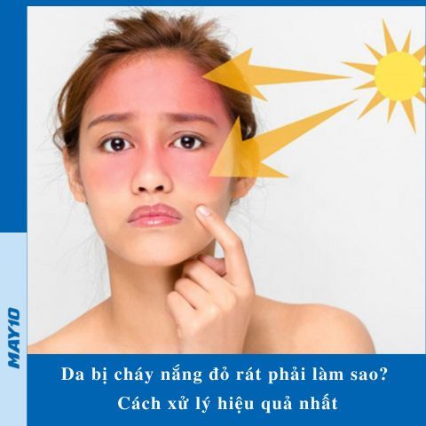 Da bị cháy nắng đỏ rát phải làm sao? 5 cách xử lý hiệu quả sau 5 phút
