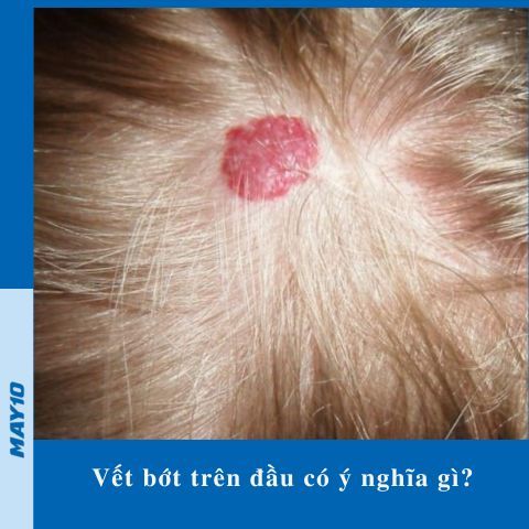 Vết bớt trên đầu có ý nghĩa gì? Đoán vận mệnh qua vết bớt