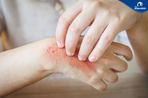 Mẩn ngứa mùa hè và những đồ uống giúp hết mẩn ngứa cấp tốc