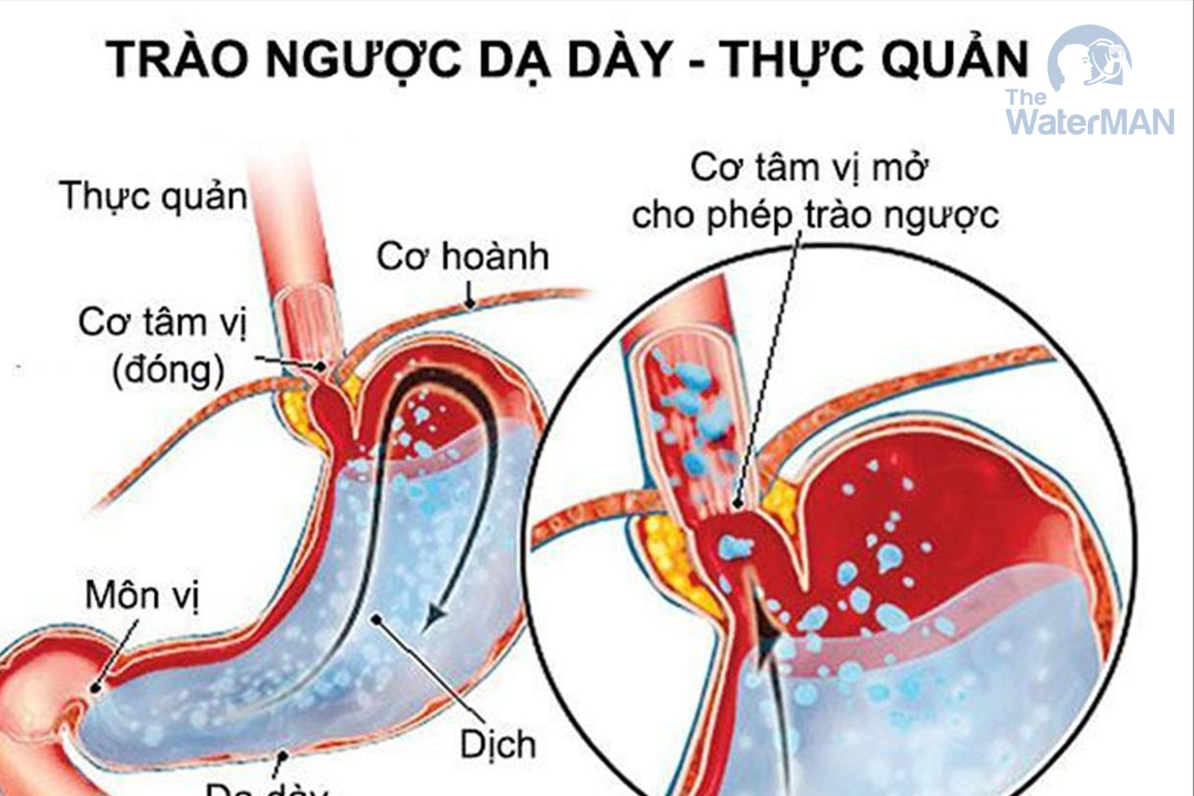 Biểu hiện của trào ngược dạ dày