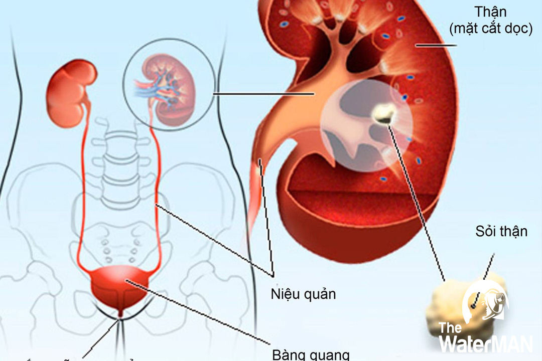 Nước có TDS cao làm tăng nguy cơ gây sỏi thận