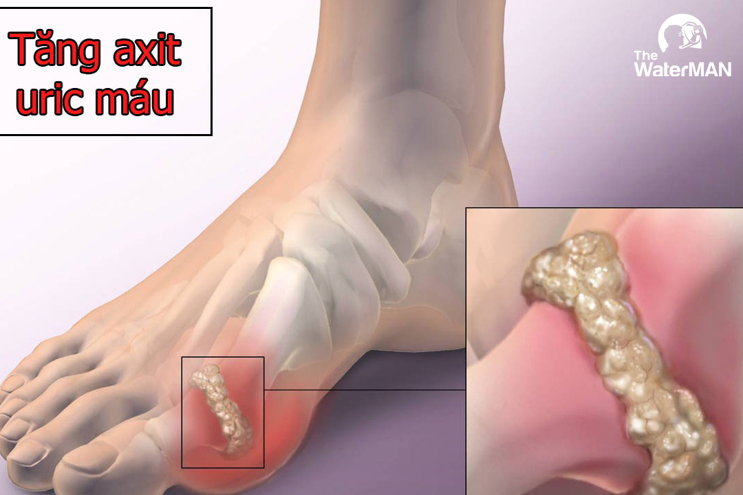 Gout sinh ra do tăng lượng axit uric trong máu