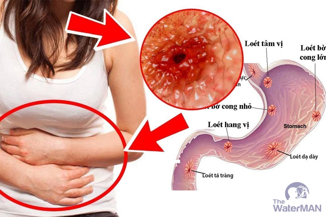 Norovirus trong nước bẩn có khả năng cao trong gây bệnh về ruột