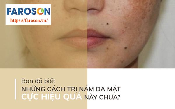 nám da mặt vùng má