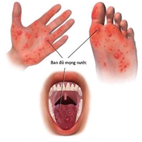 Bệnh Tay chân miệng – Dấu hiệu nhận biết và Cách phòng ngừa bệnh Tay chân miệng