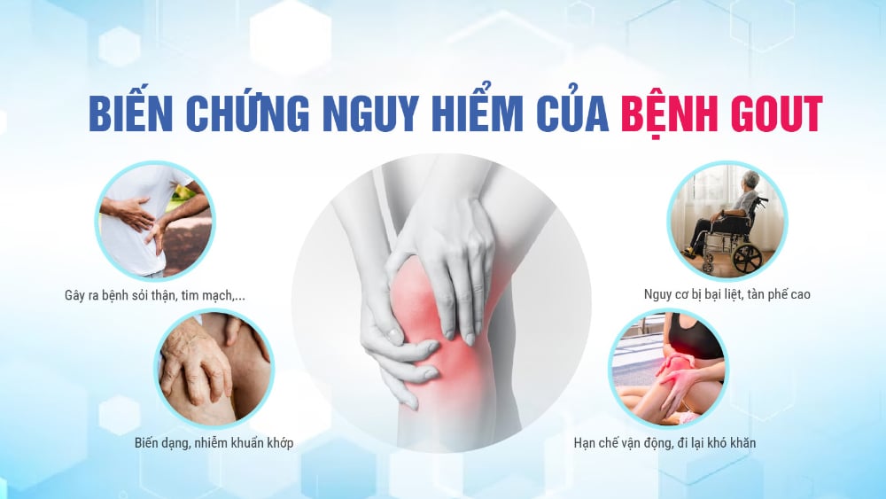 Bệnh gút ảnh hưởng thế nào đến tim, thận, mắt?
