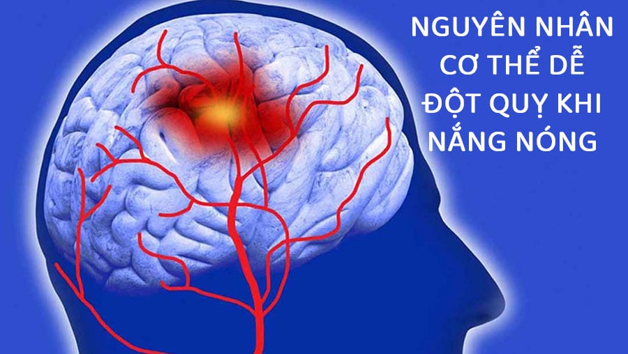 Những thói quen xấu tiềm ẩn nguy cơ đột quỵ ngày nắng nóng