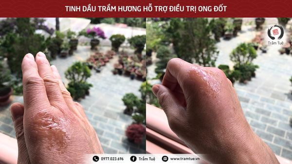 Tinh dầu Trầm hương hỗ trợ điều trị ong đốt