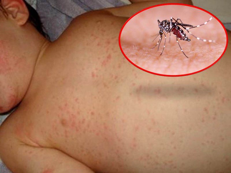 Kháng nguyên Dengue NS1: một dấu ấn sinh học mới cho chẩn đoán sớm sốt xuất huyết Dengue ngay từ ngày đầu tiên sau khi xuất hiện sốt