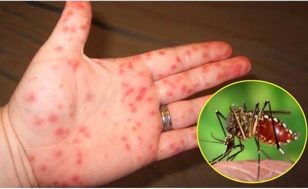 muỗi là nguyên nhân gây bệnh sốt xuất huyết