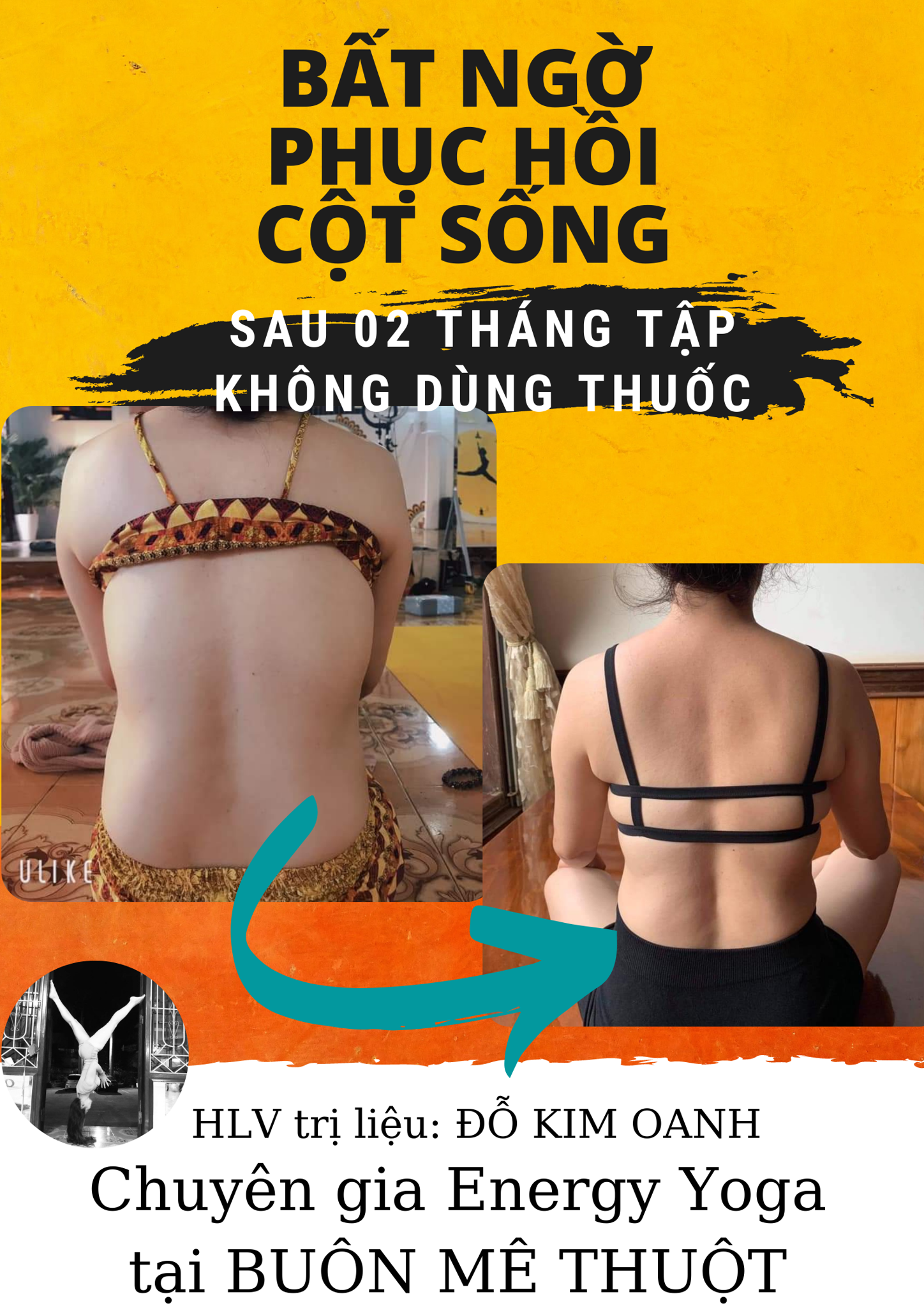 cong vẹo cột sống