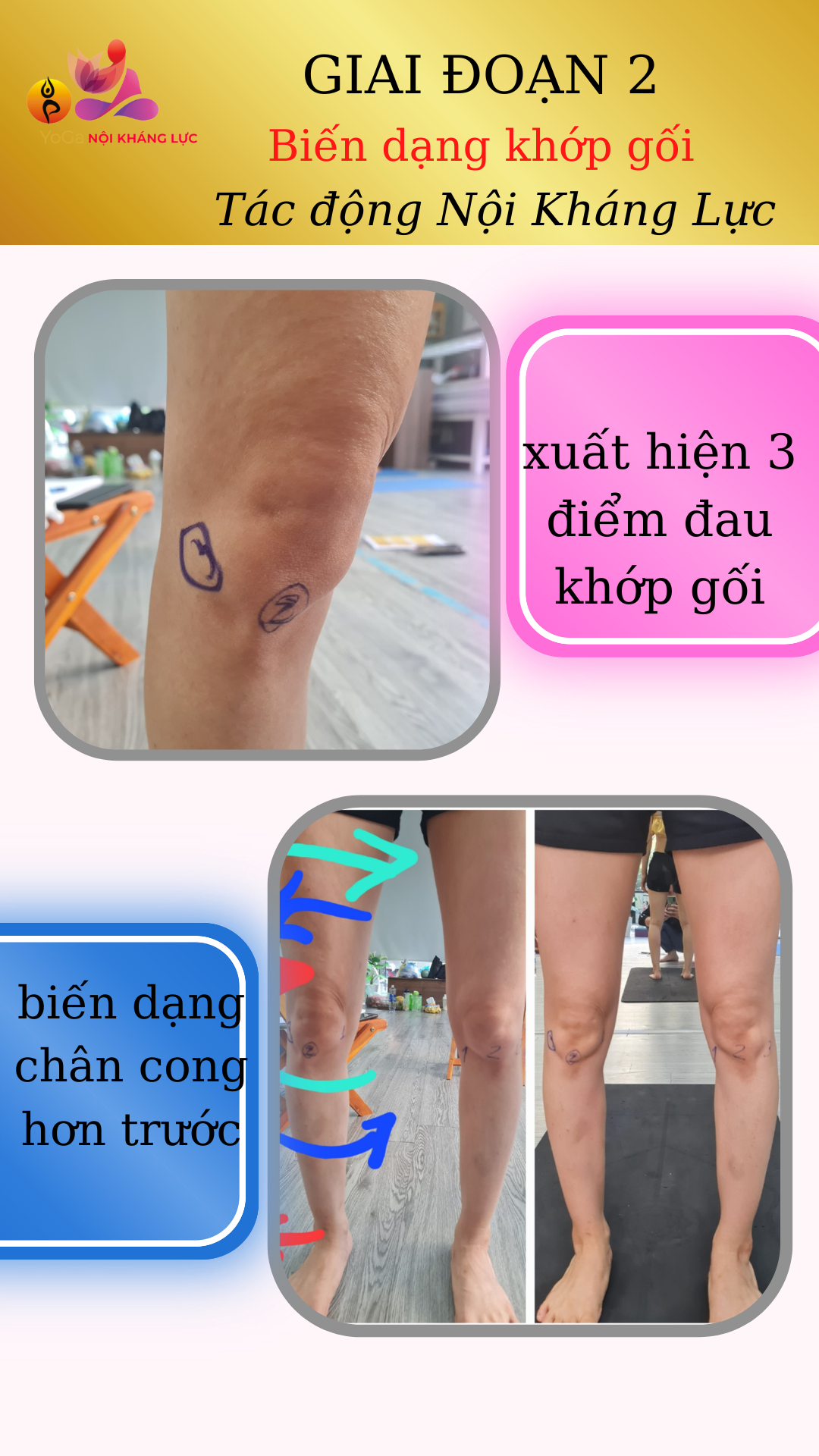 nội kháng lực khớp gối