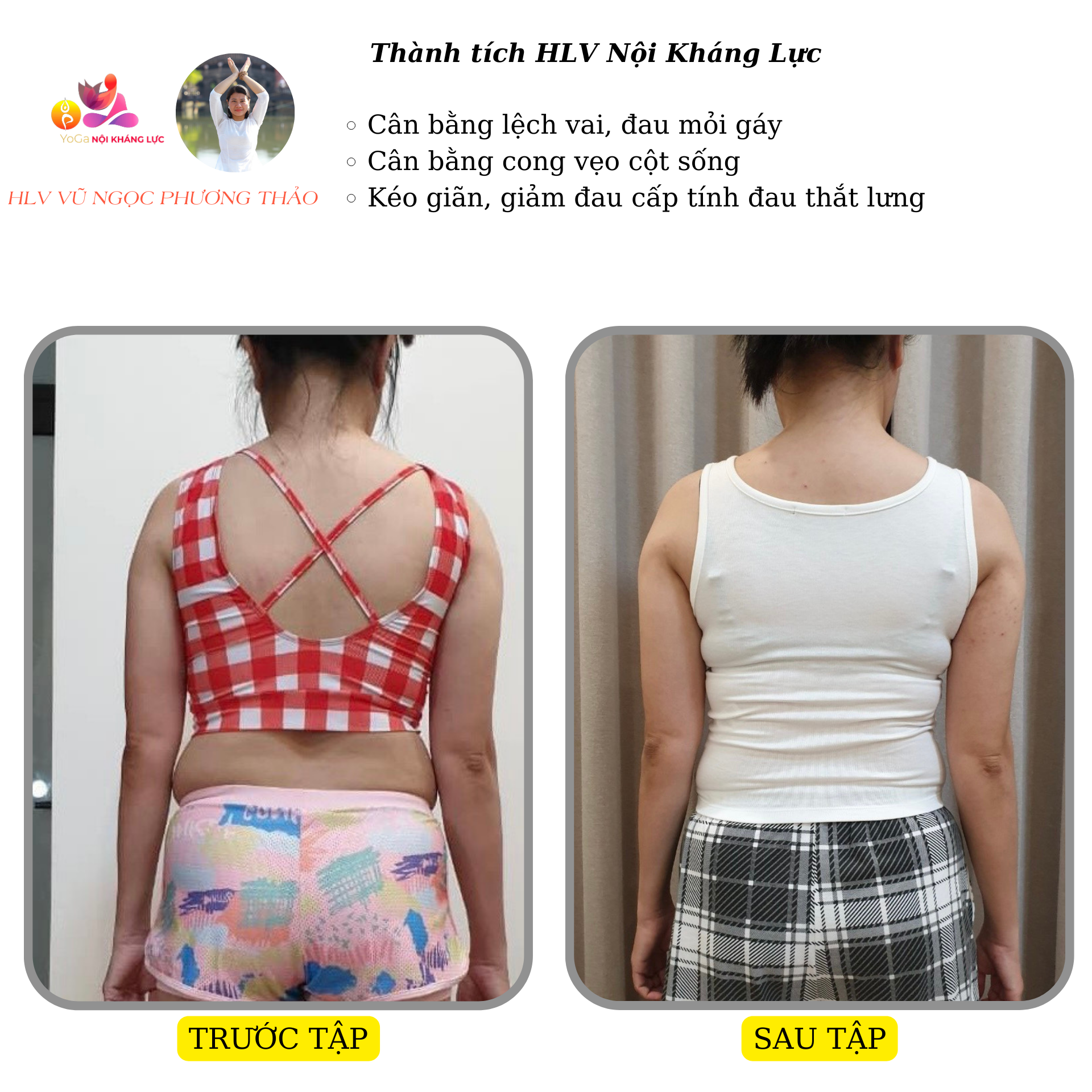 cong vẹo cột sống