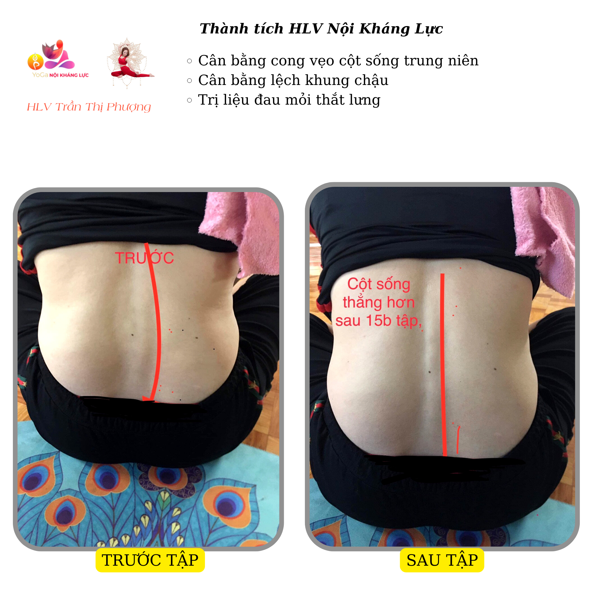 cong vẹo cột sống
