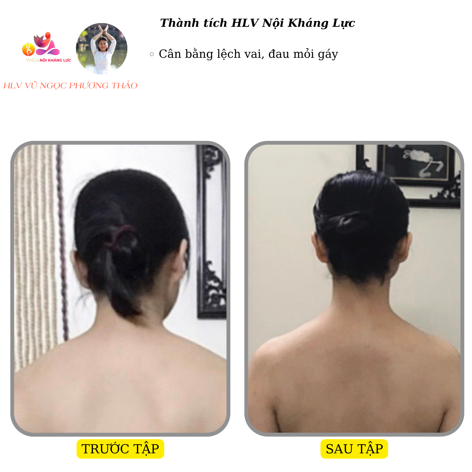 cong vẹo cột sống