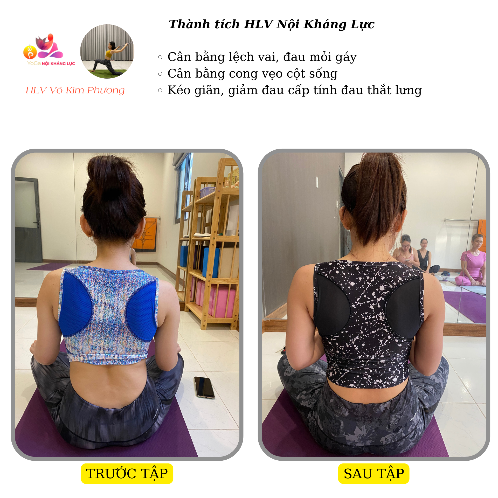 cong vẹo cột sống