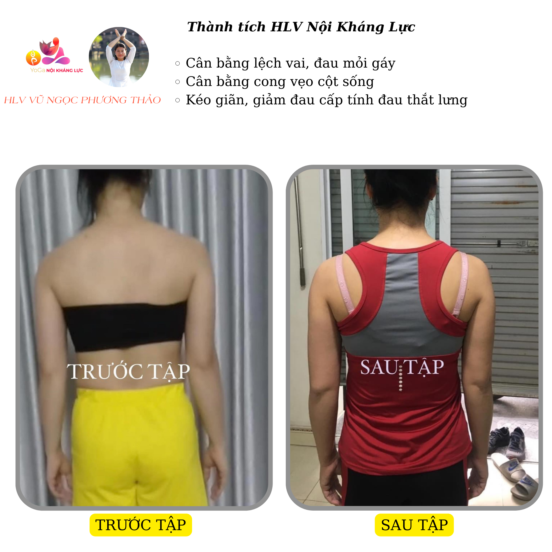 cong vẹo cột sống