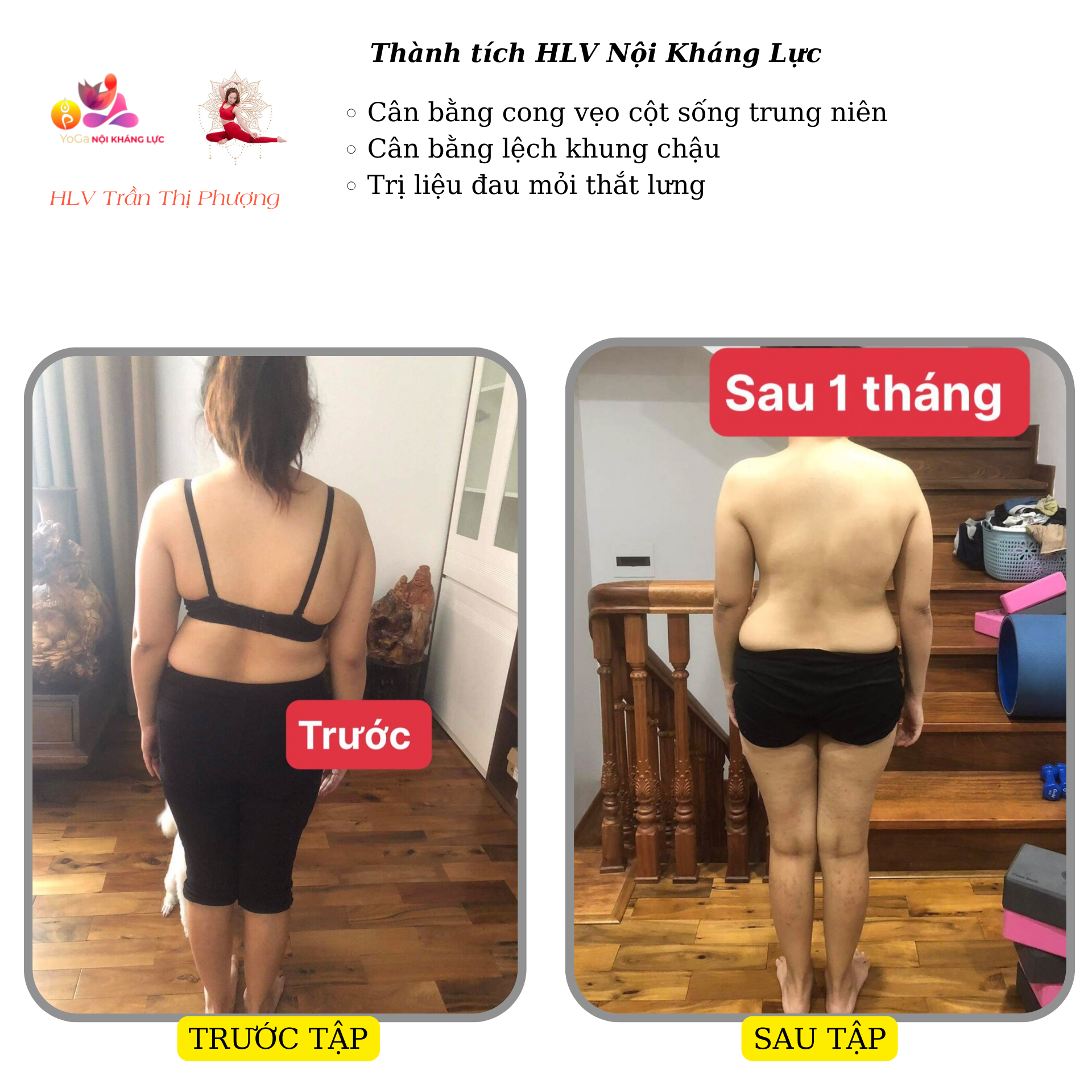 cong vẹo cột sống