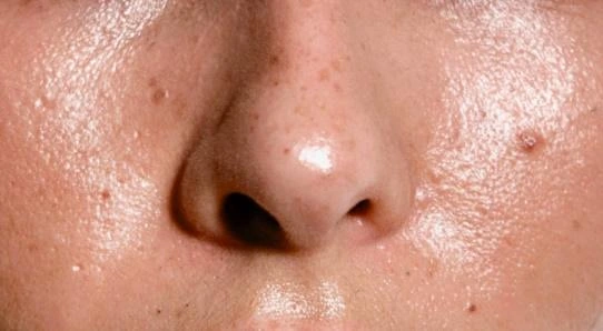 Da dầu là gì? Nguyên nhân và cách chăm sóc da dầu hiệu quả