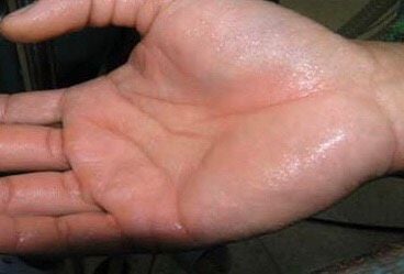 Trị bệnh đỗ mồ hôi tay, chân