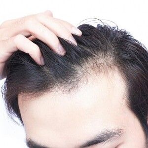 Làm thế nào để ngăn ngừa hói đầu?