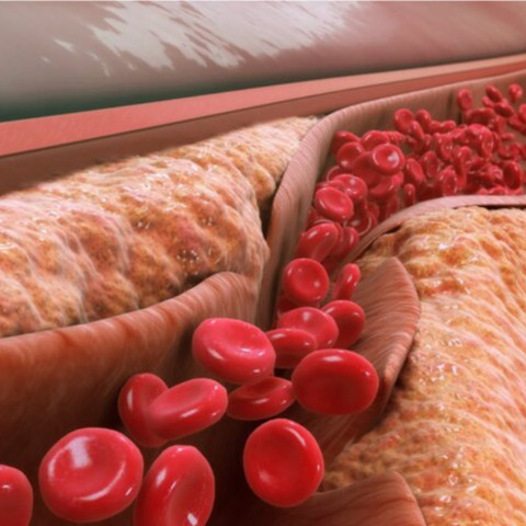 Những Nguyên Nhân Khiến Hàm Lượng Cholesterol Tăng Cao