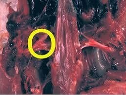 Khối u ở gan, lách, dạ dày tuyến, dây thần kinh đùi do Marek
