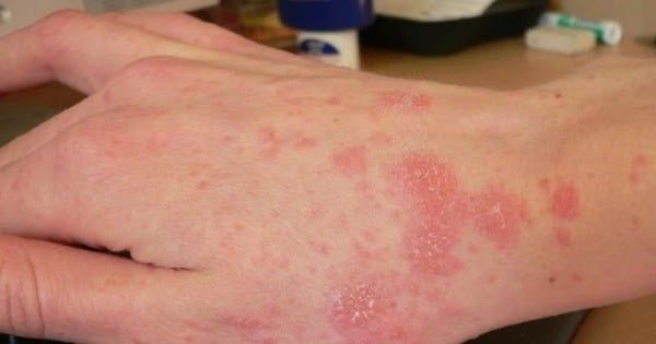 Các triệu chứng trên da do ô nhiễm không khí