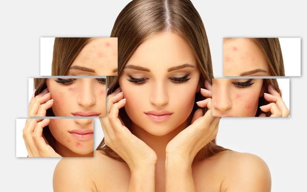 Cách chăm sóc da mụn giúp da mịn màng, tươi sáng