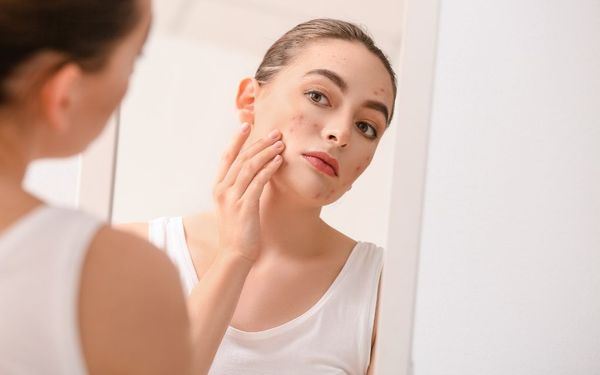 Chăm sóc da mụn bằng phương pháp tự nhiên - Giải pháp an toàn và hiệu quả