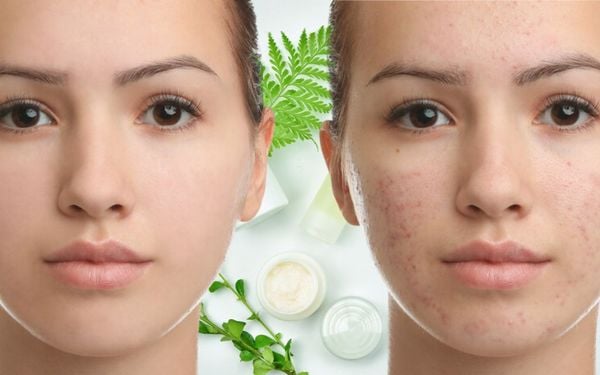 Giải cứu làn da mụn: Mỹ phẩm trị mụn hiệu quả cho làn da không tì vết