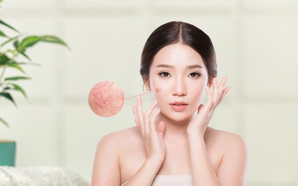 Phương pháp chăm sóc giúp phục hồi da mỏng nổi mạch máu