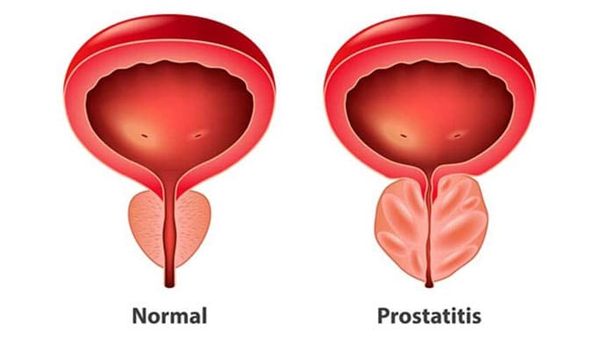 prostatitis hang