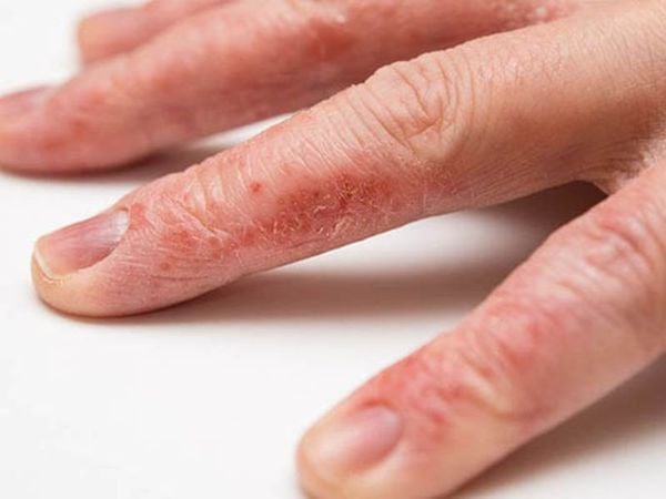 Các bệnh lý khác liên quan tình trạng bong/lột da tay