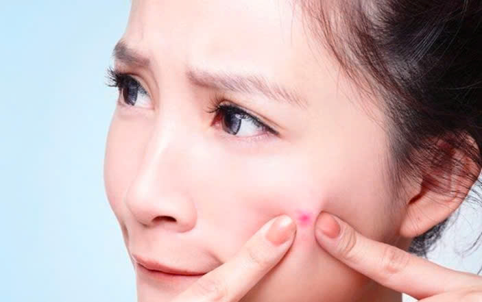 Mụn Trứng Cá Ở Tuổi Dậy Thì: Nguyên Nhân, Dấu Hiệu & Cách Phòng Ngừa