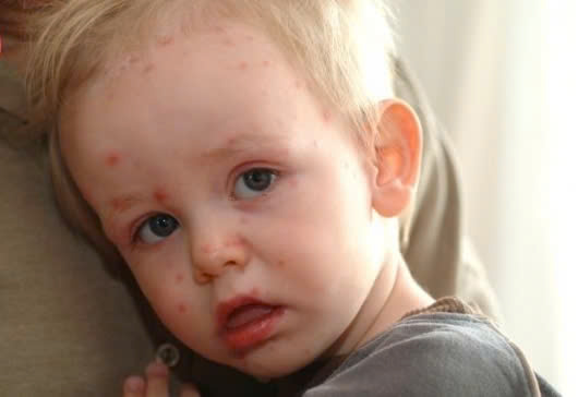 Bệnh Tay Chân Miệng: Nguyên Nhân, Dấu Hiệu Nhận Biết và Cách Phòng Ngừa