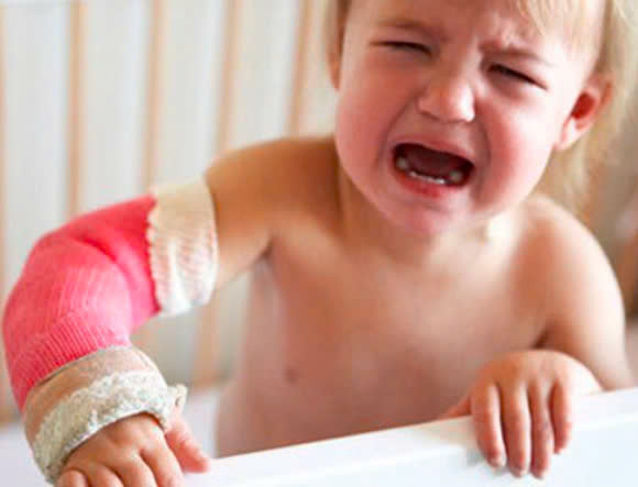 PHÂN LOẠI GÃY XƯƠNG VÀ GÃY XƯƠNG CÀNH TƯƠI