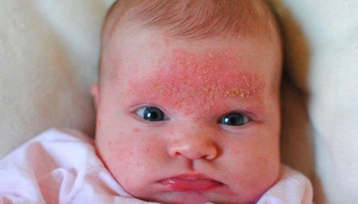 VIÊM DA DỊ ỨNG (CHÀM DA)