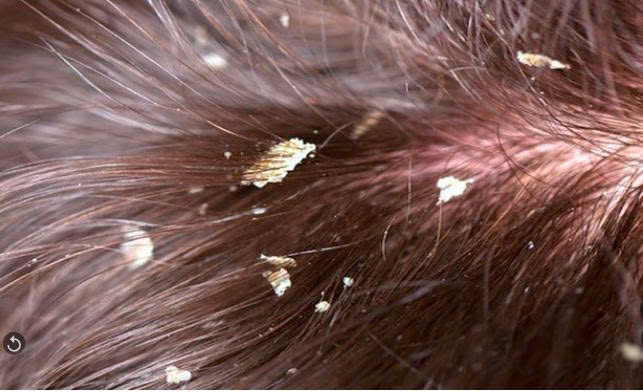 GÀU: NGUYÊN NHÂN VÀ CÁCH LOẠI BỎ