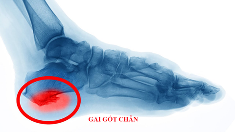 Đẩy Lùi Cơn Đau Do Gai Gót Chân Bằng Lót Giày Y Khoa Spenco