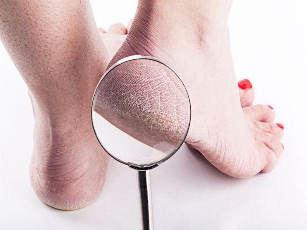 CHAI CHÂN: NGUYÊN NHÂN VÀ GIẢI PHÁP CẢI THIỆN HIỆU QUẢ ĐƯỢC CÁC BÁC SĨ KHUYÊN DÙNG