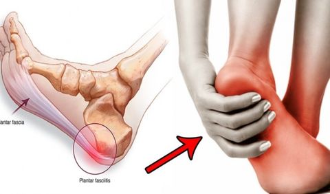 Tổng hợp các phương pháp điều trị đau gót chân