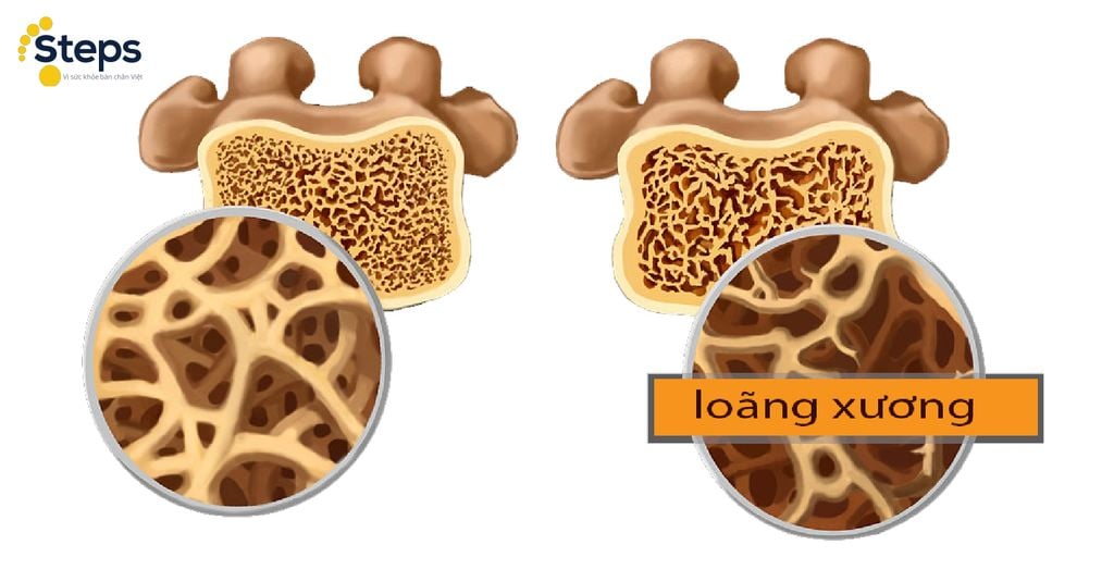 4. Kết quả xét nghiệm Beta Crosslaps