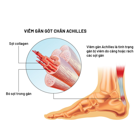 VIÊM GÂN ACHILLES: NGUYÊN NHÂN - DẤU HIỆU - GIẢI PHÁP ĐIỀU TRỊ HIỆU QUẢ ĐƯỢC CÁC BÁC SĨ KHUYÊN DÙNG