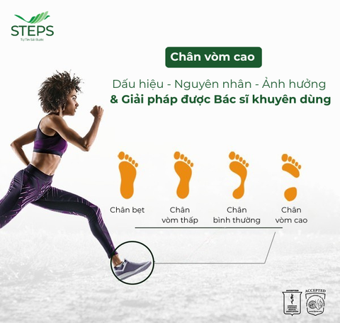 Chân vòm cao: Dấu hiệu, nguyên nhân, ảnh hưởng và giải pháp được Bác sĩ khuyên dùng
