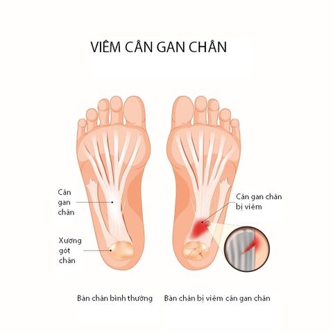 Viêm cân gan chân: Nỗi ám ảnh và giải pháp từ giày dép hoặc lót giày chỉnh hình