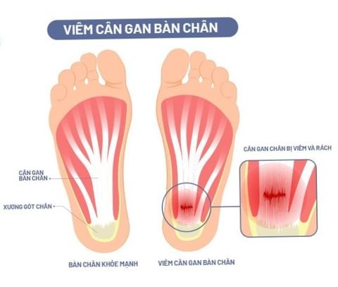 VIÊM CÂN GAN CHÂN: NGUYÊN NHÂN, TRIỆU CHỨNG VÀ GIẢI PHÁP HIỆU QUẢ CHỈ TỪ 14 NGÀY ĐƯỢC BÁC SĨ KHUYÊN DÙNG