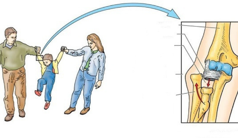 Kéo tay trẻ em, coi chừng bán trật chỏm quay